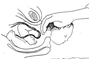 Saat Membantu Persalinan, Perawat Tarik Kepala Bayi Hingga Putus