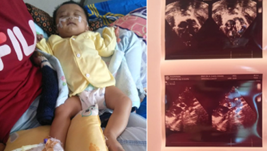 Bayi 4 Bulan di Sungai Penuh Menderita Jantung Bocor Butuh Bantuan