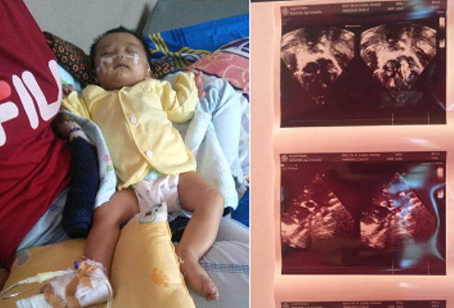 Bayi 4 Bulan di Sungai Penuh Menderita Jantung Bocor Butuh Bantuan